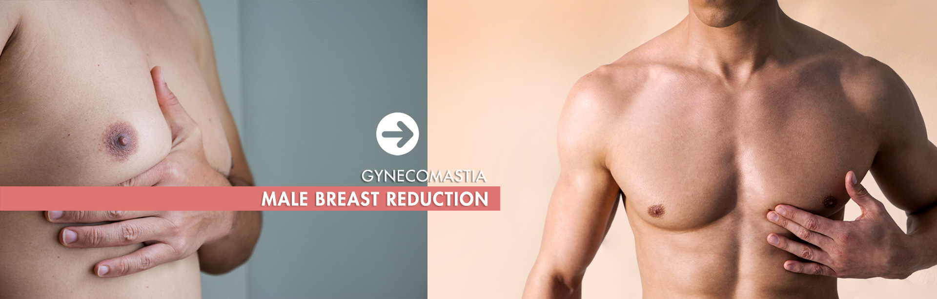 Male_Breast_Reduction