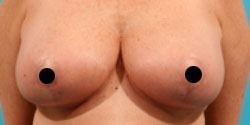 breast-reduction1