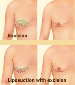 Liposuction with excision